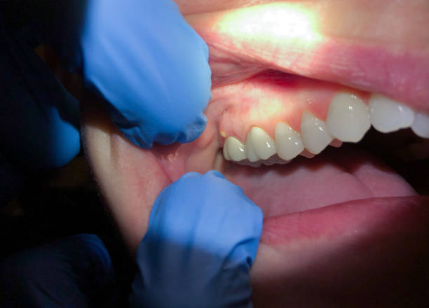 Best Emergency Dentist for Knocked-Out Tooth in Echelon, NJ